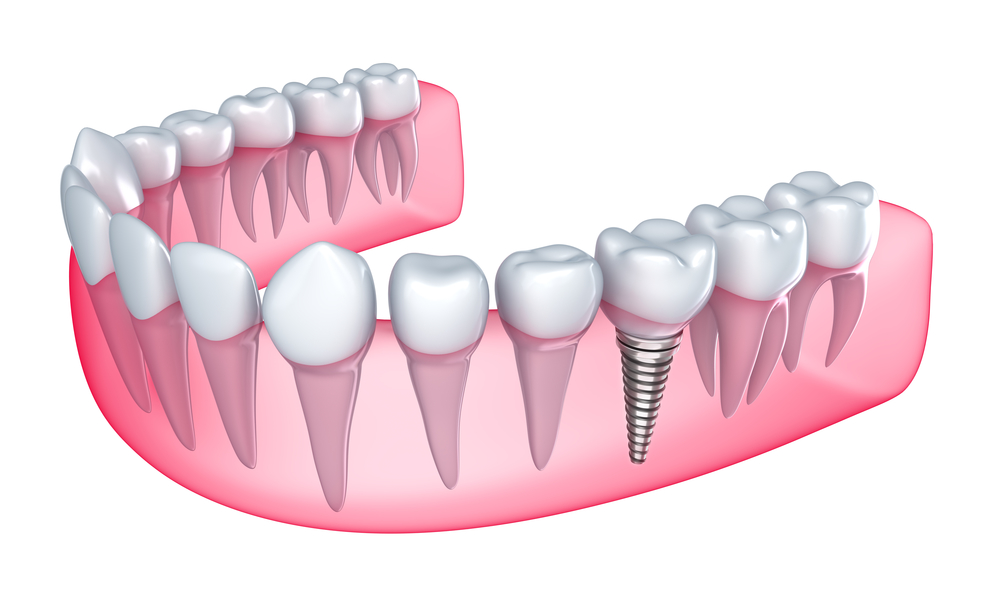 Dental implant diagram